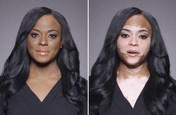 Must See: Fearless Black Woman Shares Her Struggles With Vitiligo