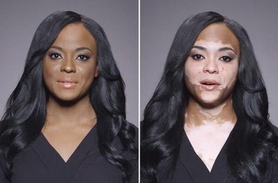 Must See: Fearless Black Woman Shares Her Struggles With Vitiligo
