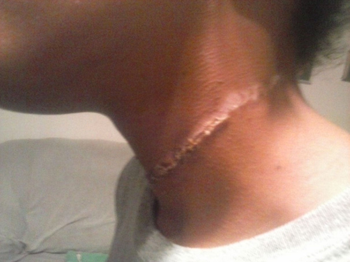 Parents Sue School After Daughter Comes Home With Rope Burns Around Her Neck