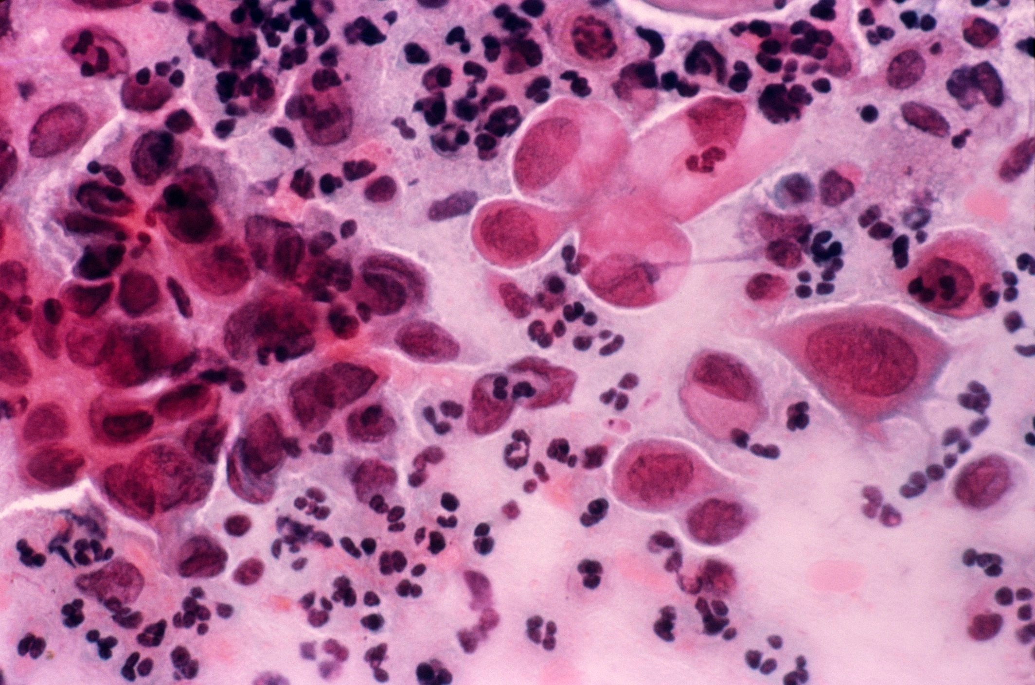 Cervical Cancer Deaths Rates Are Much Higher Than Previously Thought, Study Says
