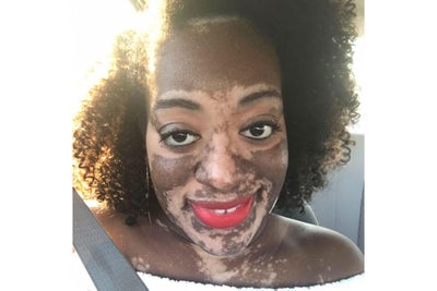 Bride Struggles With Vitiligo Before Her Wedding: ‘It Has Made Me A Stronger Person’