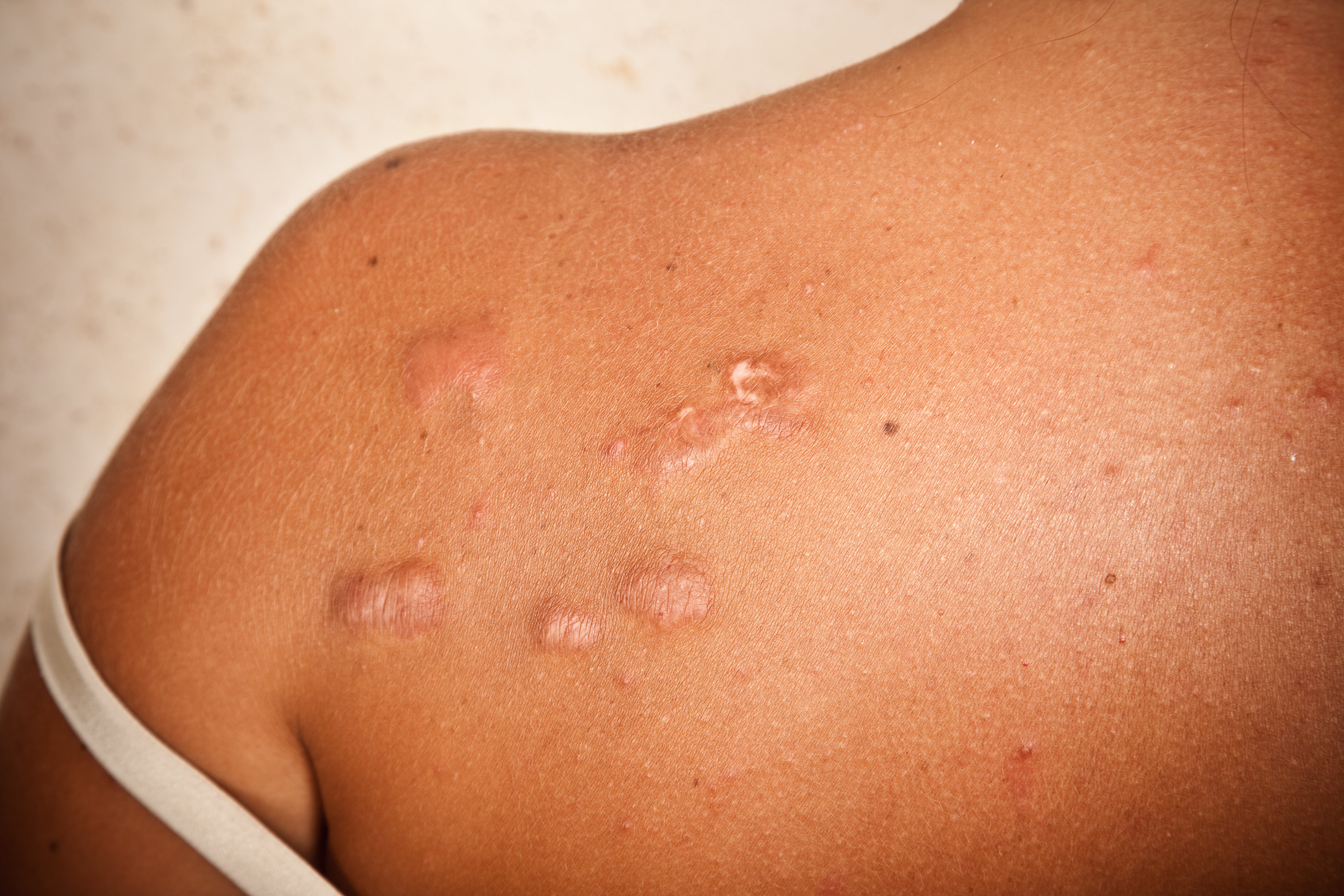 Black Skin Care 101: What Are Keloid Scars and How Can Black Women Get Rid of Them?