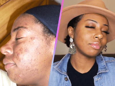 Face It Sis!: Redefining My Relationship With Bumps And Beauty