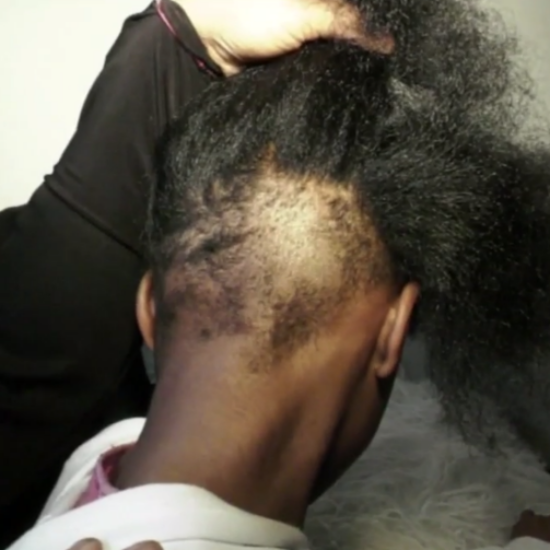 Philadelphia Mom Says Daughter's Hair Was Cut Out By Classmate