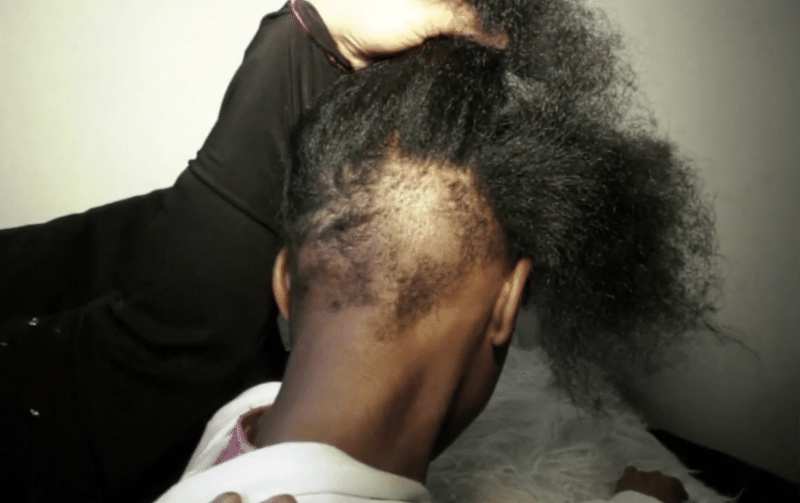 Philadelphia Mom Says Daughter’s Hair Was Cut Out By Classmate