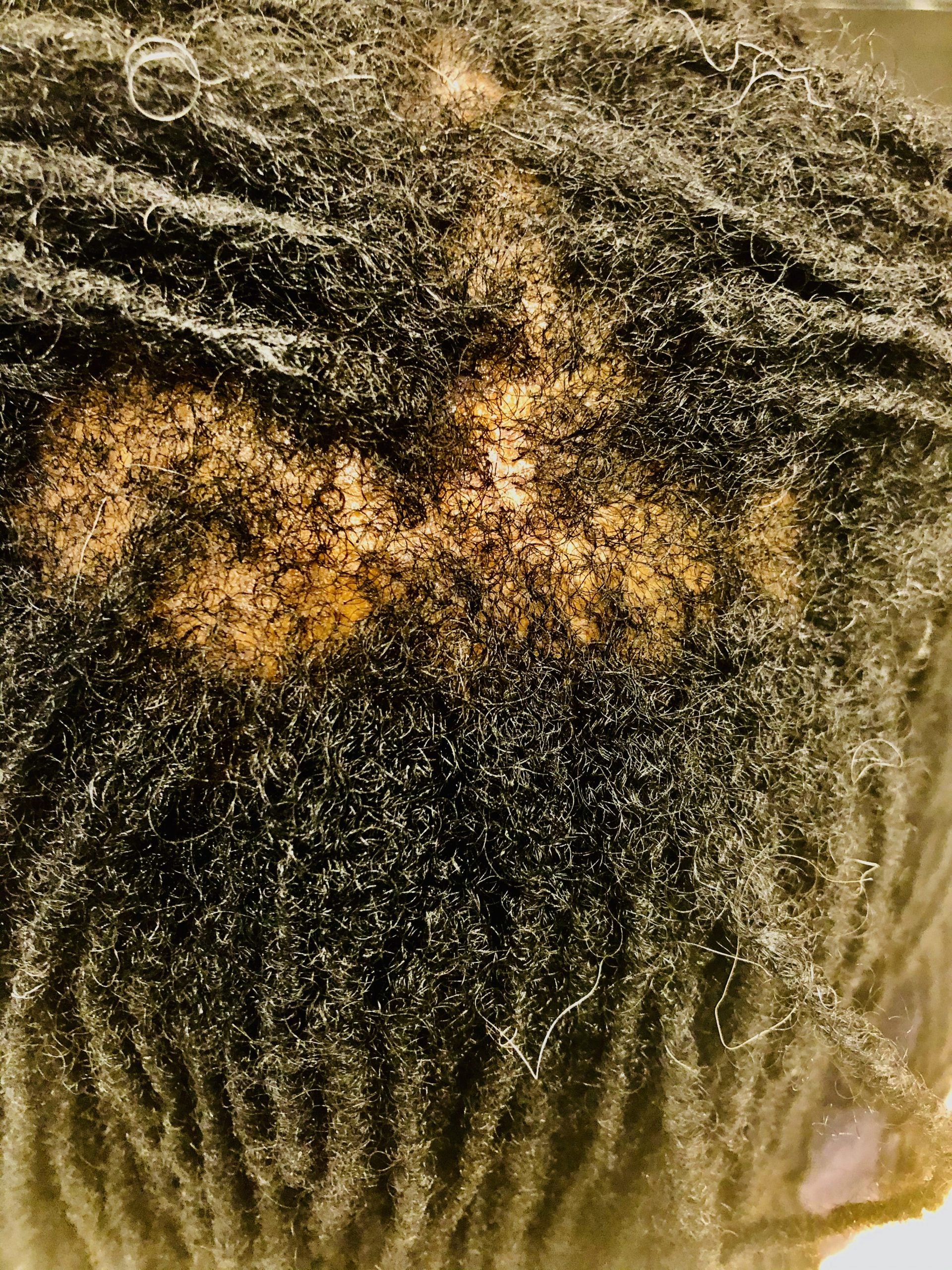 Losing Your Hair? This Is Why You Need A Scalp Analysis