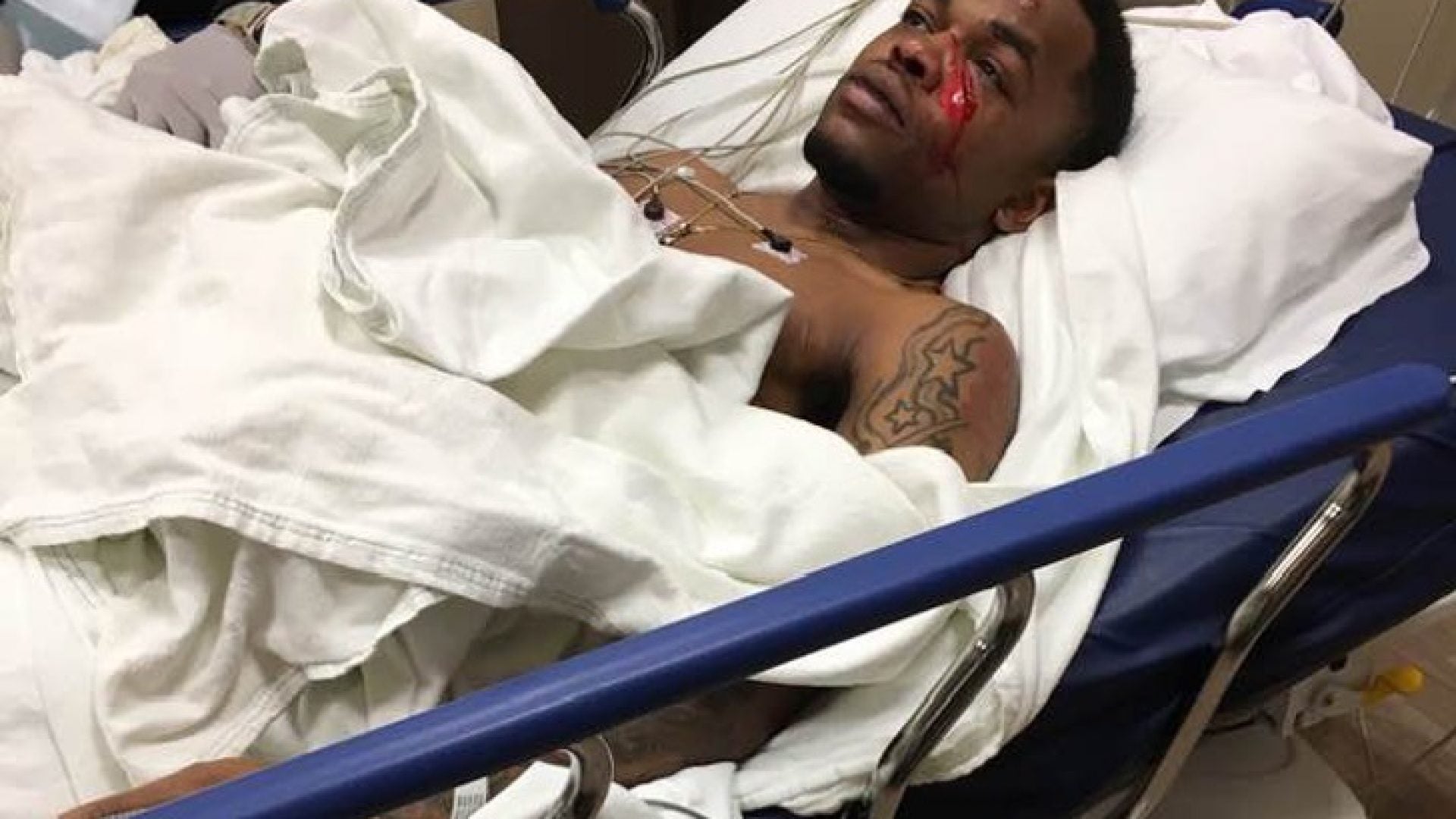 Police Investigating After 22-Year-Old Says White Men Broke Face In 5 Places