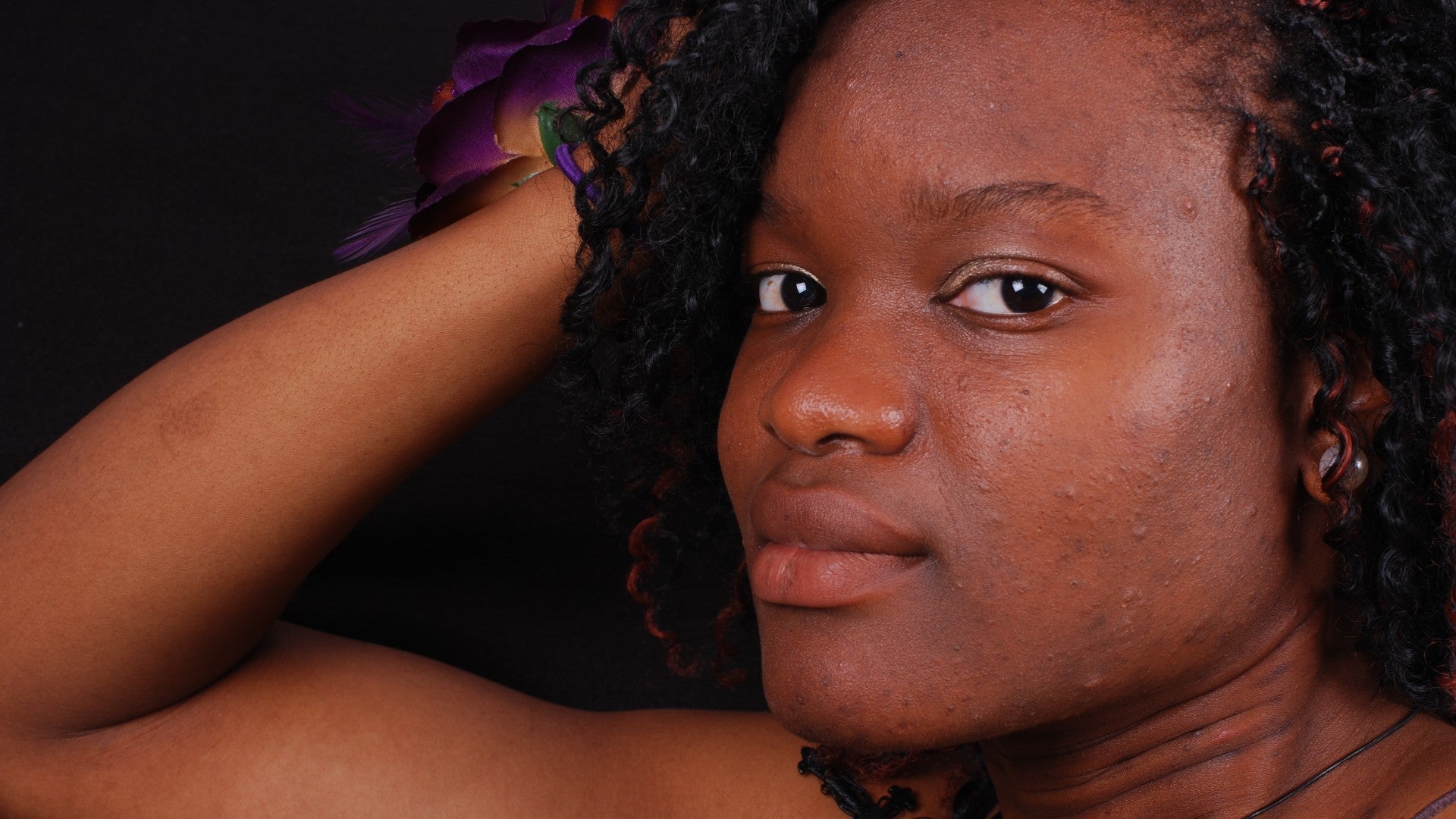 This Key Ingredient Could Help You Prevent Hyperpigmentation