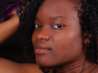 This Key Ingredient Could  Help You Prevent Hyperpigmentation