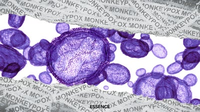 What Is Monkeypox? A Breakdown Of The Virus, Symptoms, And Misconceptions