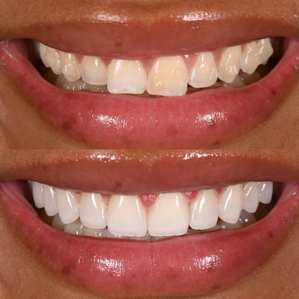 Talkin’ Teeth: Inside One Woman’s Veneers Journey