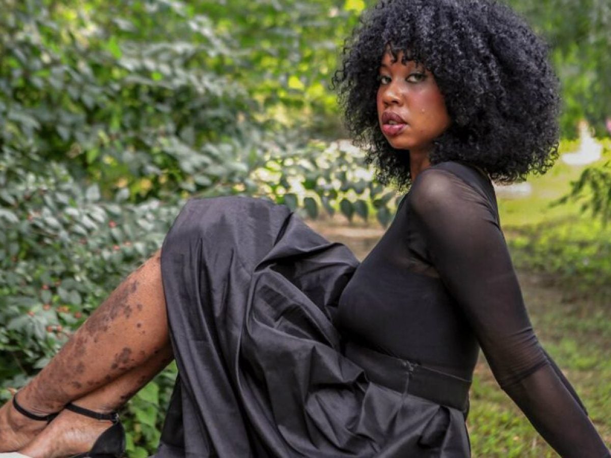 Living with Plaque Psoriasis as a Black Woman Isn’t Easy: Alisha Bridges Won’t Let the Disease Define Her