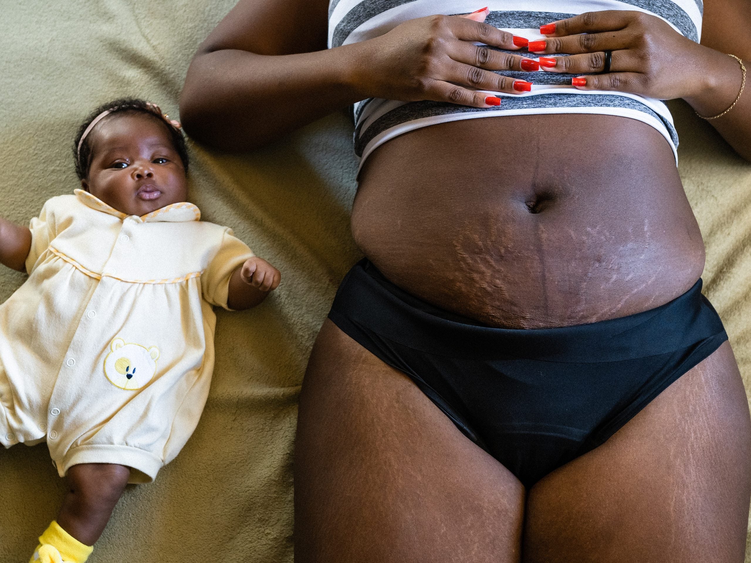 Everything To Know About Stretch Marks On Darker Skin
