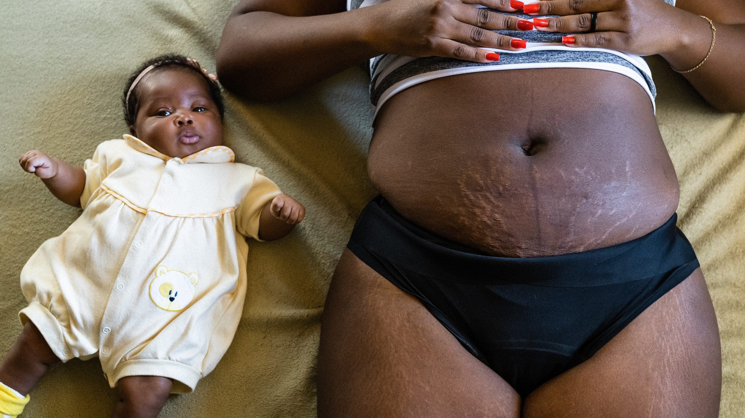 Everything To Know About Stretch Marks On Darker Skin