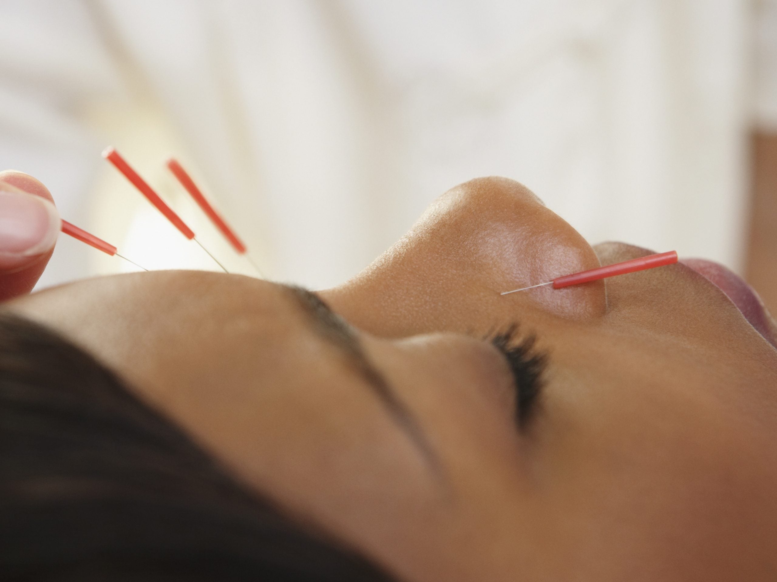 Everything You Need To Know About Facial Acupuncture