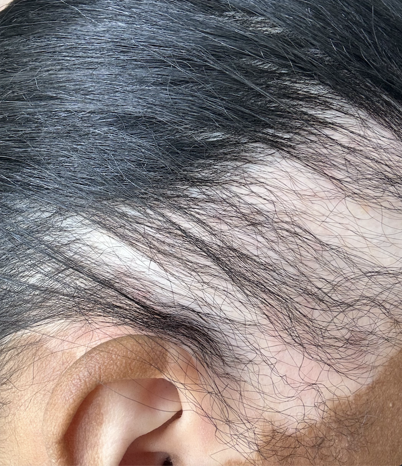 I tried PRP hair restoration – here's how it went