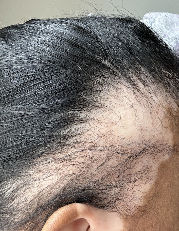 I tried PRP hair restoration – here's how it went