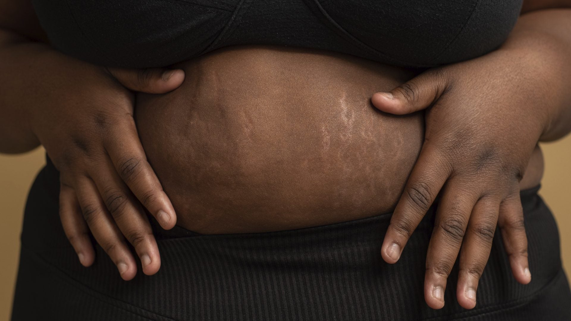 Here's Why I Finally Stopped Hiding My Stretch Marks