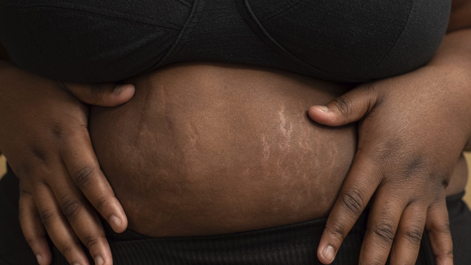 Here's Why I Finally Stopped Hiding My Stretch Marks