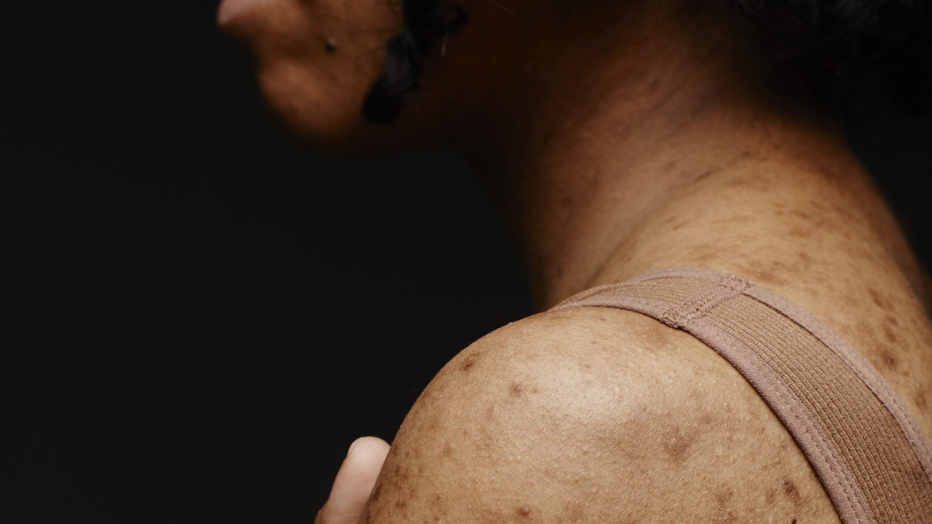 How Prioritizing Gut Health May Soothe Chronic Skin Conditions