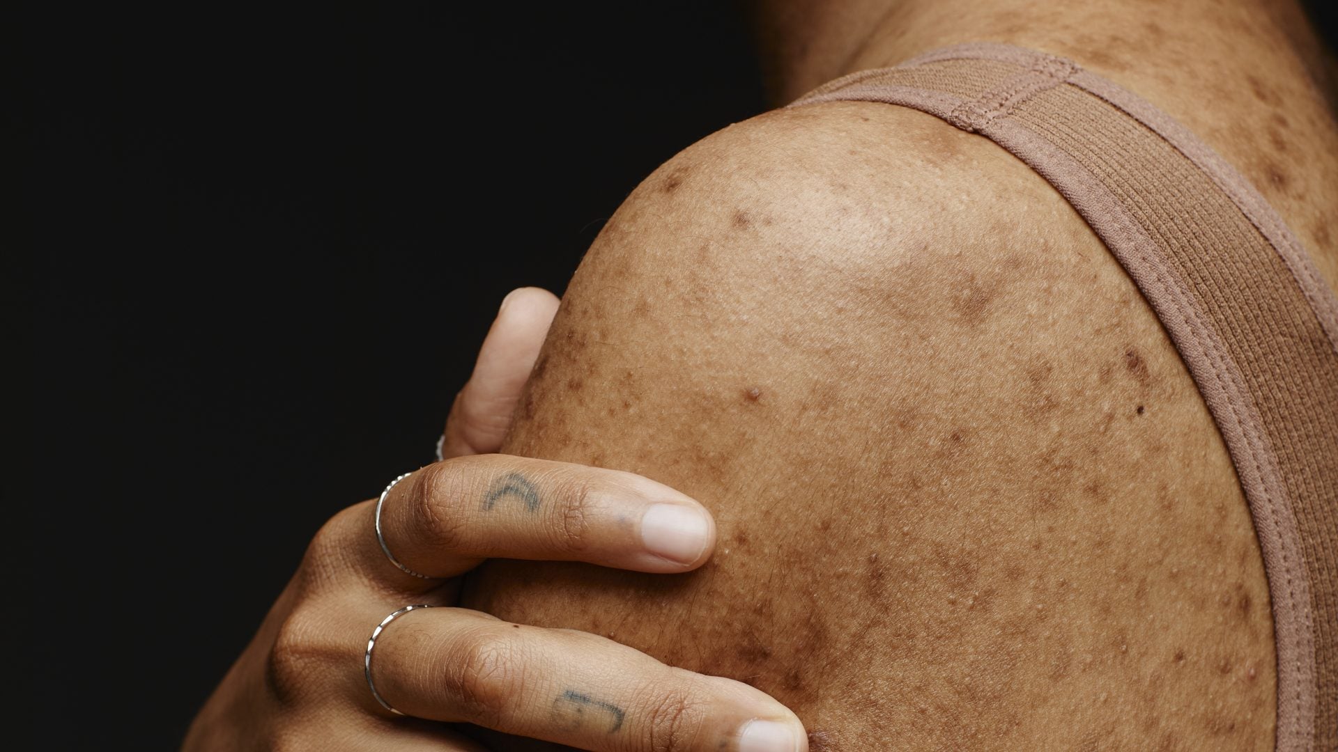 How Prioritizing Gut Health May Soothe Chronic Skin Conditions