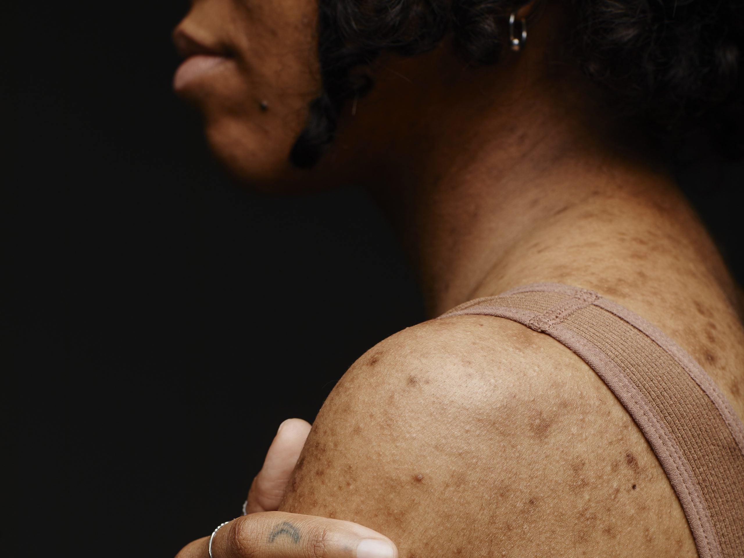 How Prioritizing Gut Health May Soothe Chronic Skin Conditions