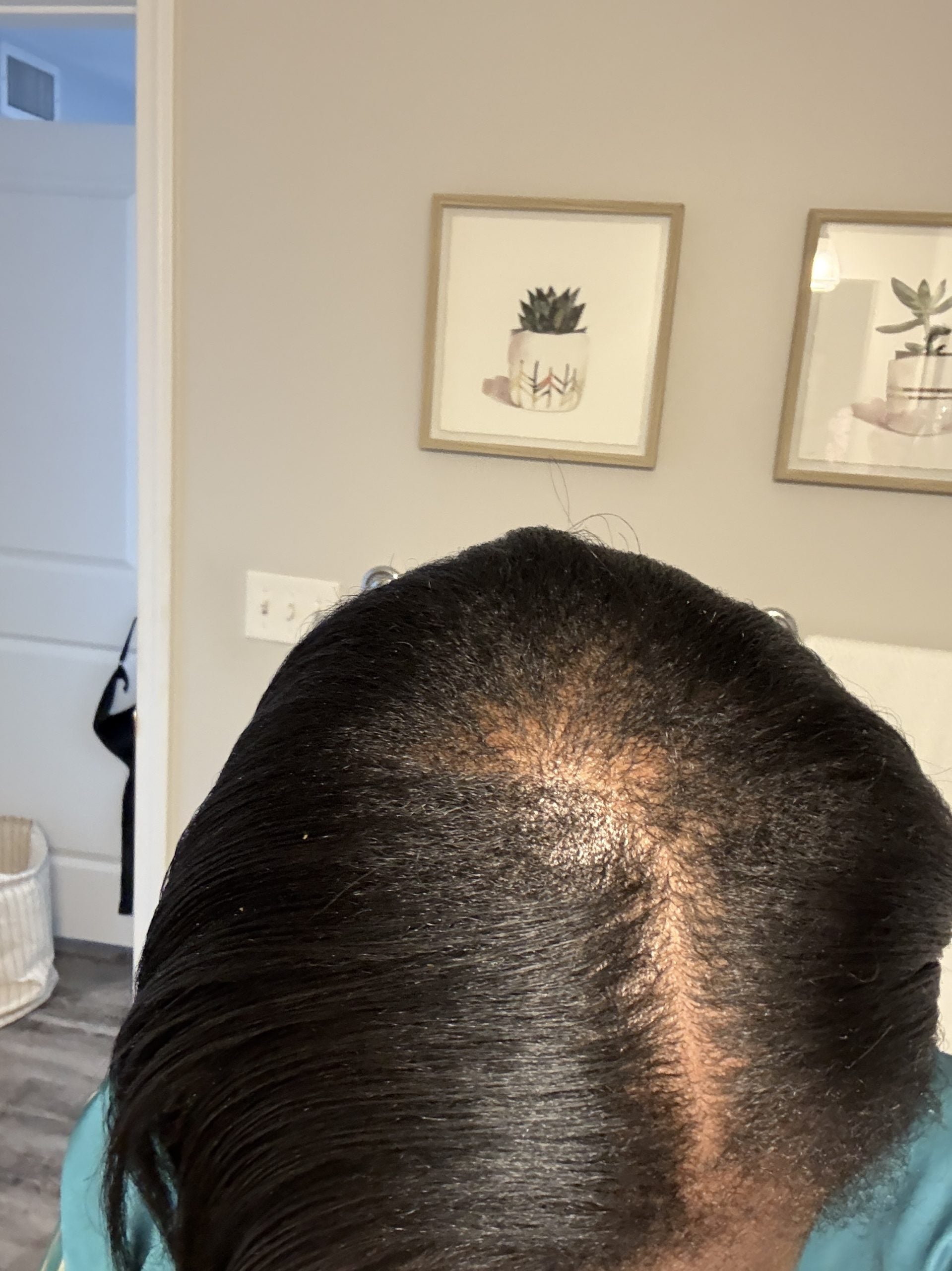 How I Regrew My Thinning Hair