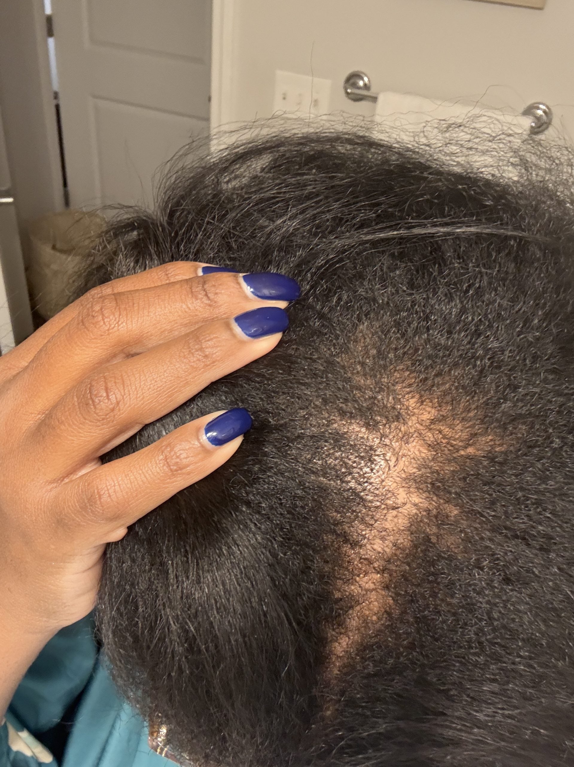 How I Regrew My Thinning Hair