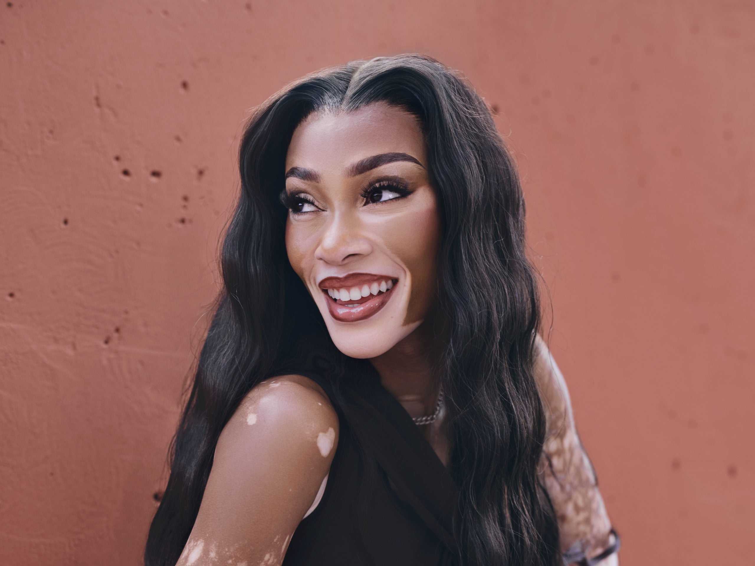 Winnie Harlow Partners With Incyte To Empower The Vitiligo Community