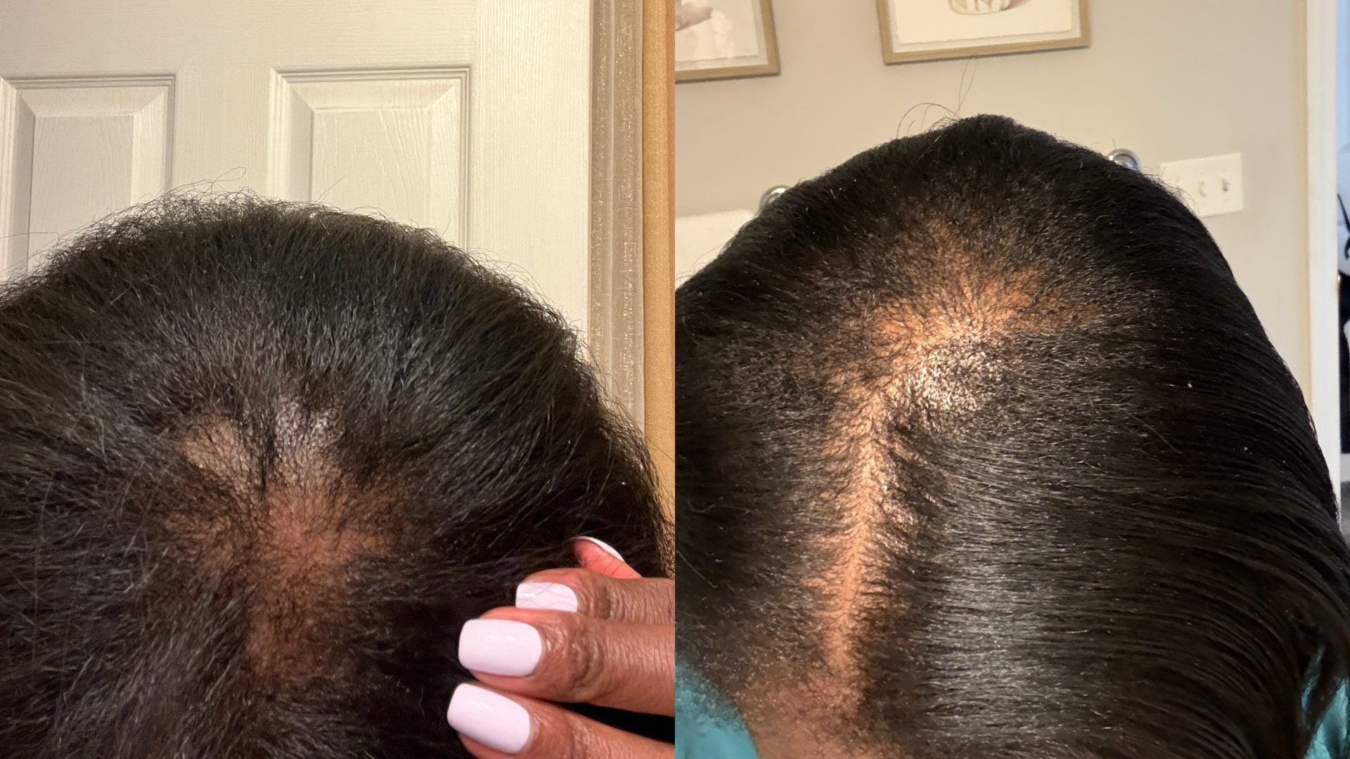 I'm A Black Woman With Thinning Hair—Here's What's Bringing My Strands Back To Life