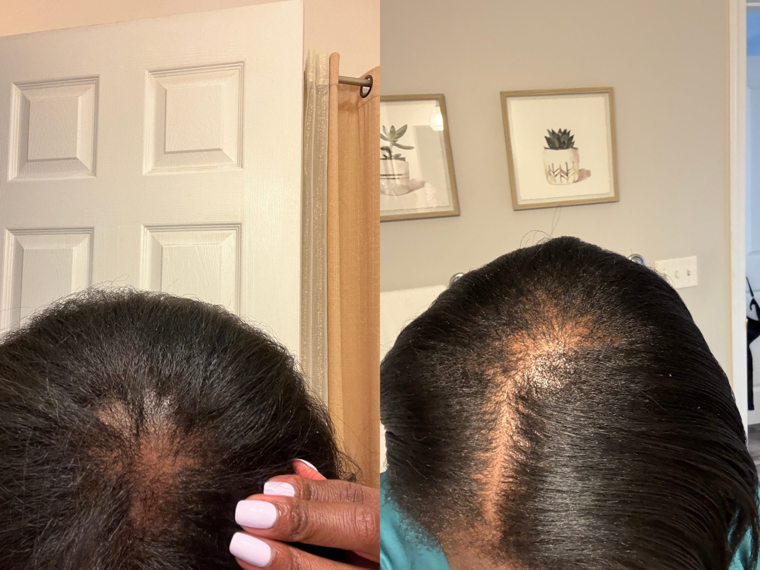 How I Regrew My Thinning Hair – Essence